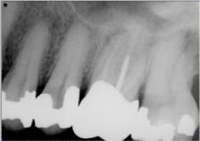 Normal Film X-Ray
